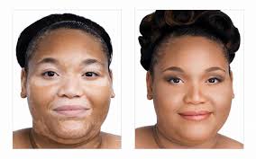Pigmen kulit yang rusak (vitiligo) bisa bagus kembali Obat-vitiligo